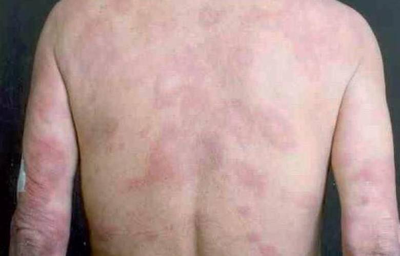 ISEM reporta cero casos de lepra en 2022