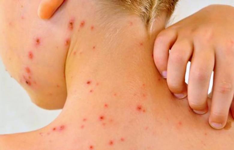 Sarampión, enfermedad recurrente 