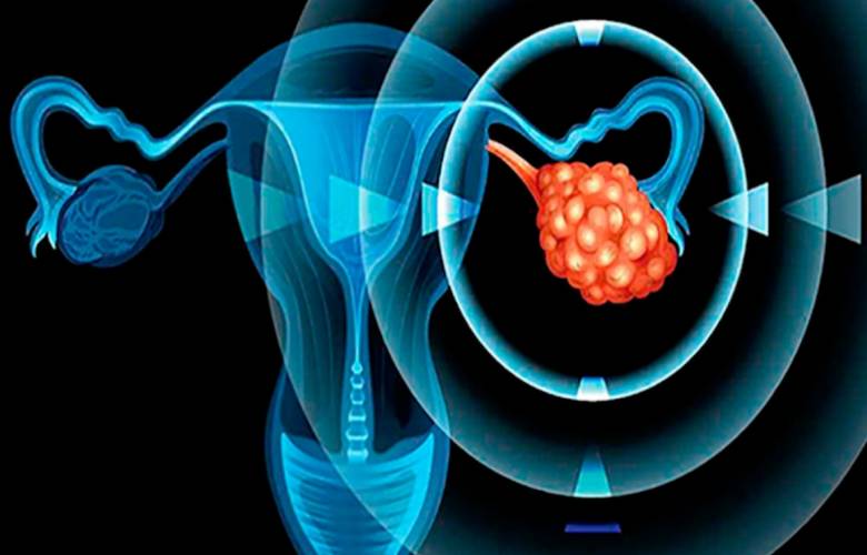 Cancer de ovario, tercera causa de muerte en mujeres