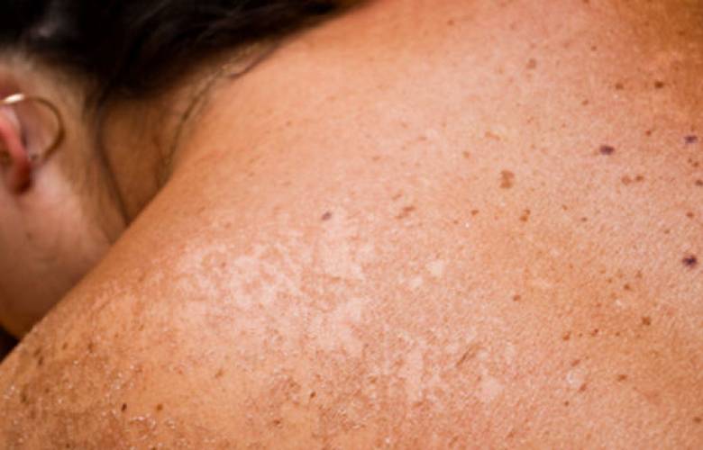 Recomienda secretaría de salud usar protector solar para prevenir cáncer de piel
